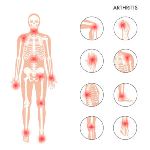 El sulfato de condroitina apoya la salud articular y ayuda a tratar la osteoartritis. Reduce el dolor, mejora la movilidad y protege el cartílago del desgaste.